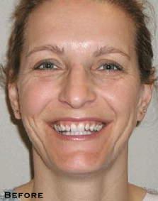 Stained, Chipped Smile - Before