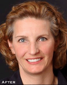 Stained, Chipped Smile - After