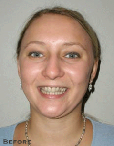 Multiple Spaces Between Teeth - Before