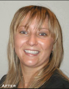 Multiple Spaces Between Teeth - After