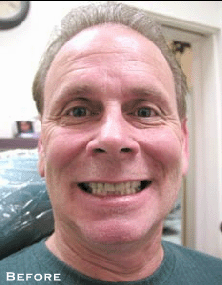 Permanent Whitening & Straightening - Before