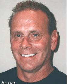 Permanent Whitening & Straightening - After