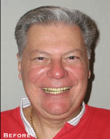 Small & Misshaped Teeth - Before