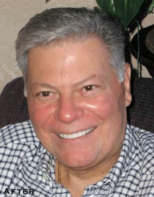 Small & Misshaped Teeth - After