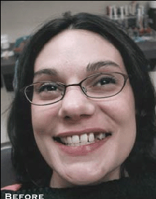 Small & Misshaped Teeth - Before