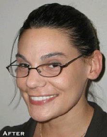 Small & Misshaped Teeth - After