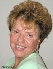 Tetracycline Stains/20 Year Recall Before