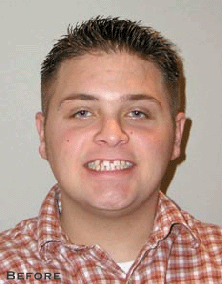 Stained, Crooked Teeth Before