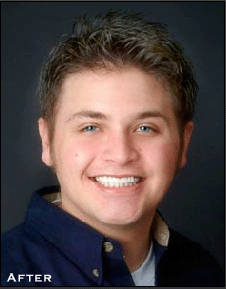 Stained, Crooked Teeth After