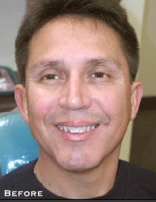 Smile Perfection with LUMINEERS Before