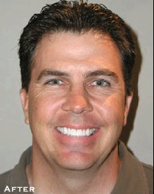 Attractive Smile Made Dramatically More - After