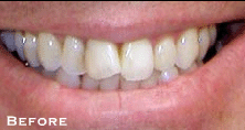 Attractive Smile Made Dramatically More - Before