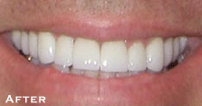 Attractive Smile Made Dramatically More - After