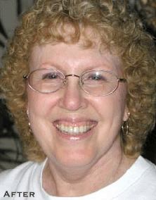 Renewing Old Dental Work - After