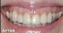 Renewing Old Dental Work - After