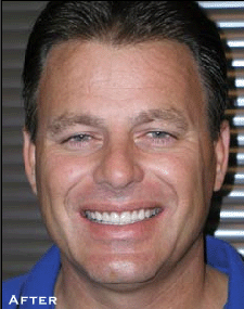 Straightening Crooked Teeth - After