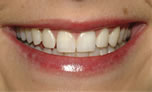 Attractive Smile Made Dramatically More - Before