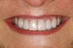 Permanent Whitening & Straightening - After