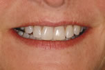 Permanent Whitening & Straightening - Before