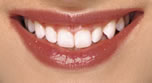Small & Misshaped Teeth - Before