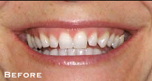 Stained, Chipped Smile - Before