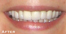 Multiple Spaces Between Teeth - After