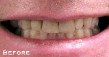 Permanent Whitening & Straightening - Before