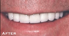 Permanent Whitening & Straightening - After