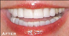 Tetracycline Stains/20 Year Recall Before