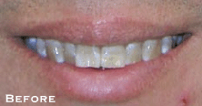 Smile Perfection with LUMINEERS Before