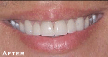 Smile Perfection with LUMINEERS After