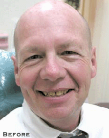 Spaced Teeth Before