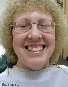 Renewing Old Dental Work - Before