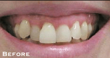 Renewing Old Dental Work - Before