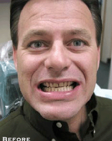 Straightening Crooked Teeth - Before
