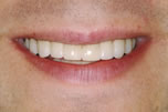 Spaced Teeth After