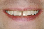 Spaced Teeth Before