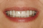 Tetracycline Stains/20 Year Recall Before