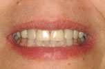 Tetracycline Stains/20 Year Recall Before