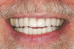Stained, Crooked Teeth After