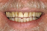 Stained, Crooked Teeth Before