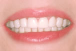 Smile Perfection with LUMINEERS After