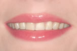 Smile Perfection with LUMINEERS Before
