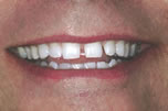 Multiple Spaces Between Teeth - Before