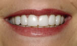 Attractive Smile Made Dramatically More - After