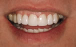 Renewing Old Dental Work - After