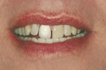 Renewing Old Dental Work - Before