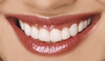 Small & Misshaped Teeth - After
