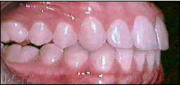 Posterior open bite example image.
