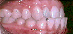 Anterior cross bite example image.